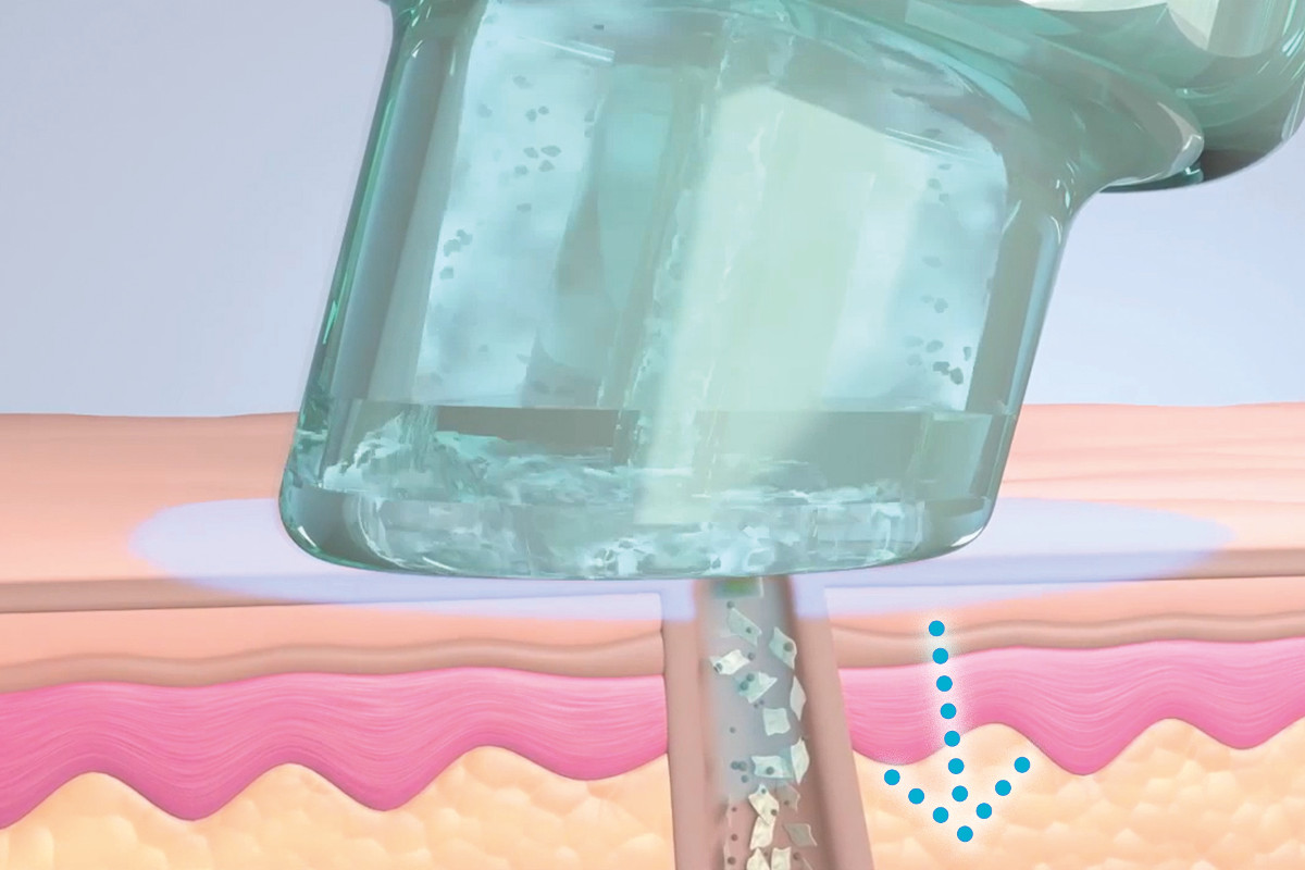 HydraFacial Schritt 2