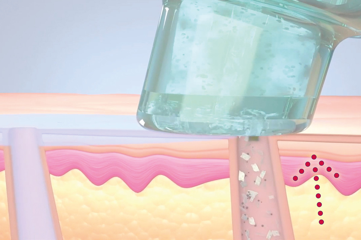 HydraFacial Schritt 3