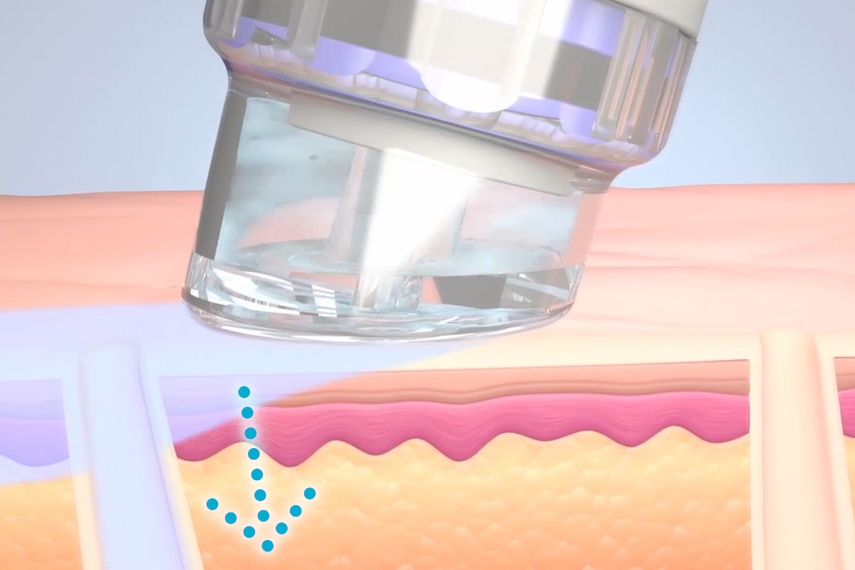 HydraFacial Schritt 4