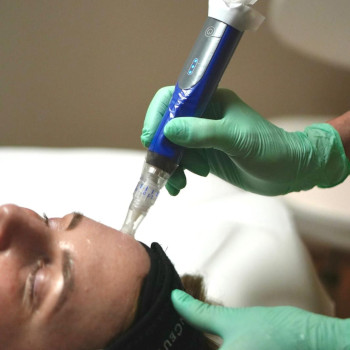 Medizinisches Microneedling und Exosom-Therapie